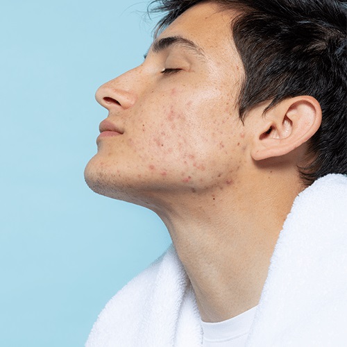 acne treatment solutions-distill laser clinic-north york