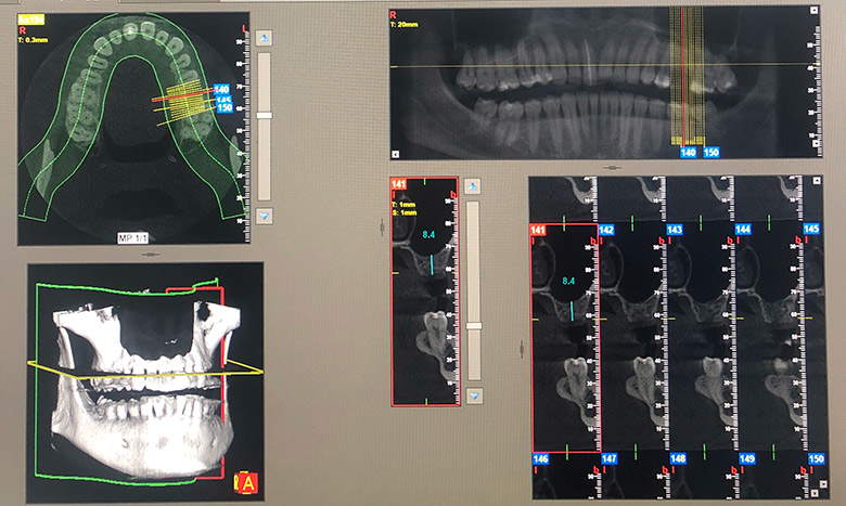 computed tomography for wisdom teeth removal - wisdom teeth professionals - sydney