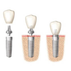 dental implants - dental implant professionals sydney