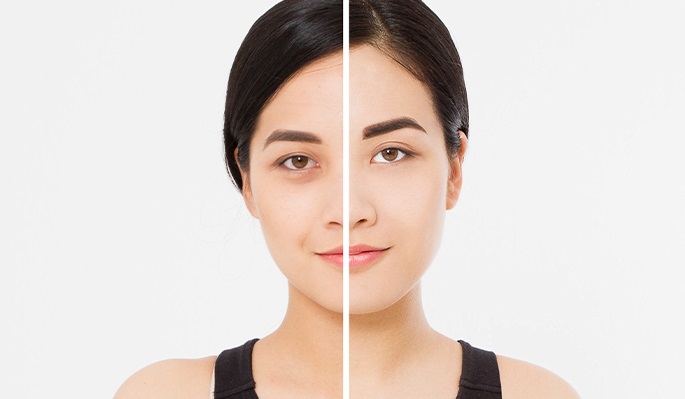 skin-rejuvenation-distill laser clinic-north york