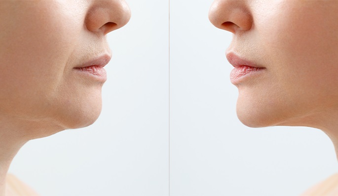 skin rejuvenation results-distill laser clinic-north york